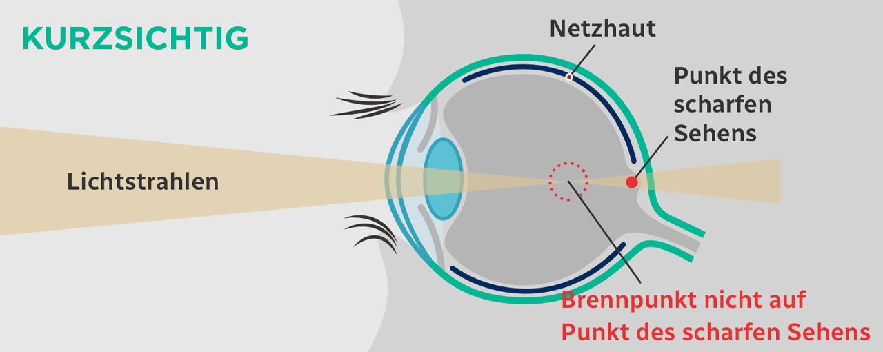 Kurzsichtigkeit Infografik