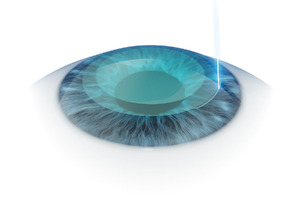 Minimalinvasiver Zugang