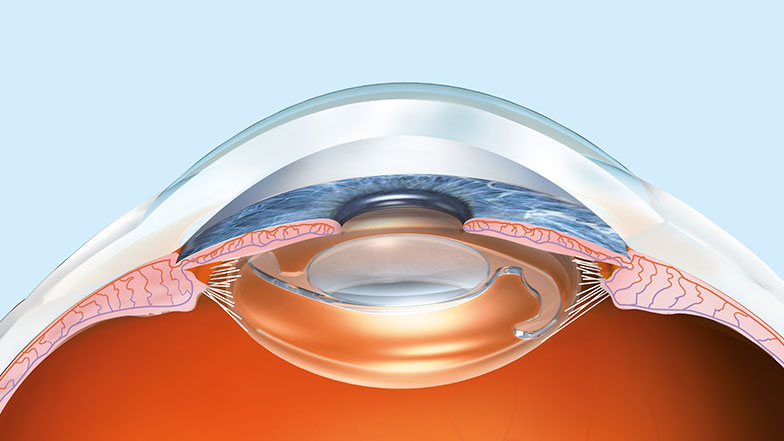 Moderne ZEISS Trifokal-Linsen (multifokal) und EVO ICL (implantierbare Kontaktlinsen)