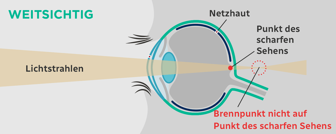 Weitsichtigkeit Infografik