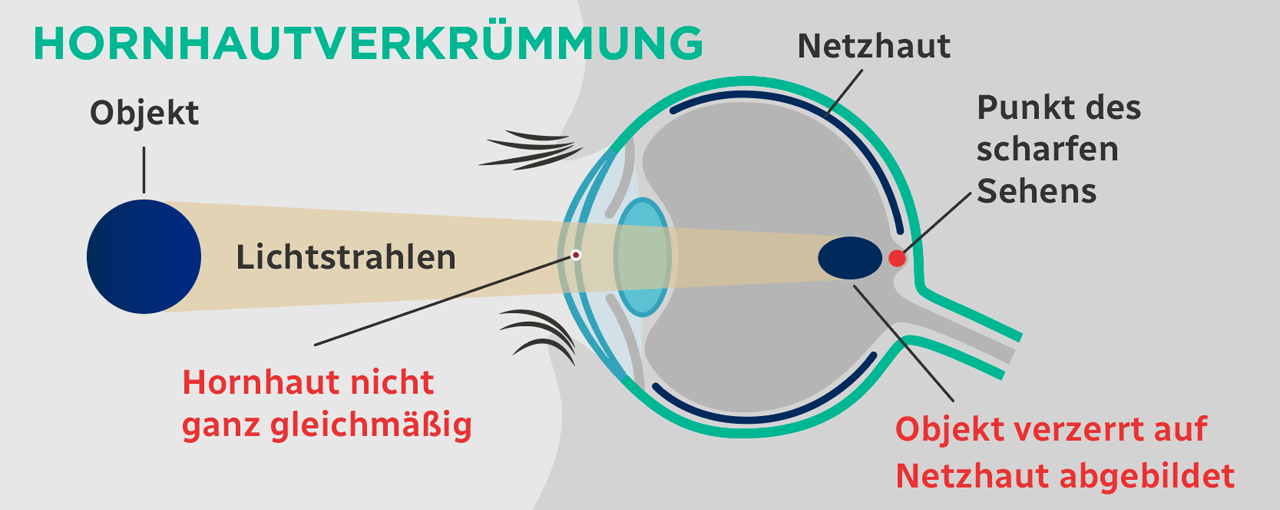 Hornhautverkrümmung Infografik